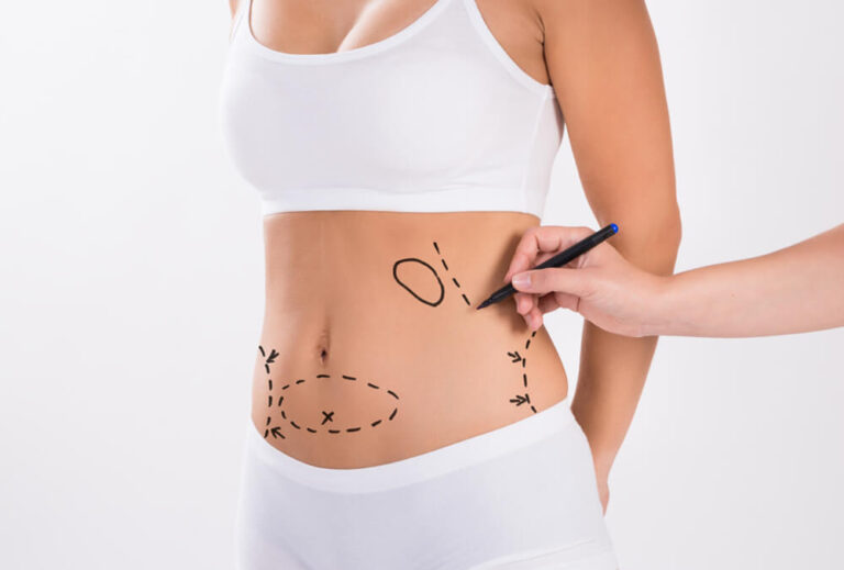 Managing Swelling and Bruising After Liposuction