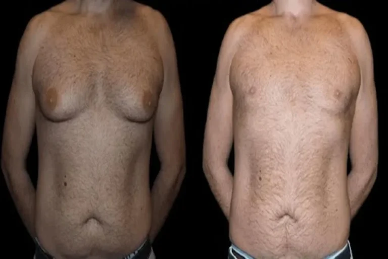 Avoid Common Pitfalls After Male Breast Reduction Surgery