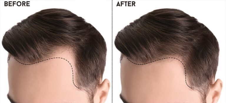 Hair Transplants in Islamabad Ultimate Guide to Transplant