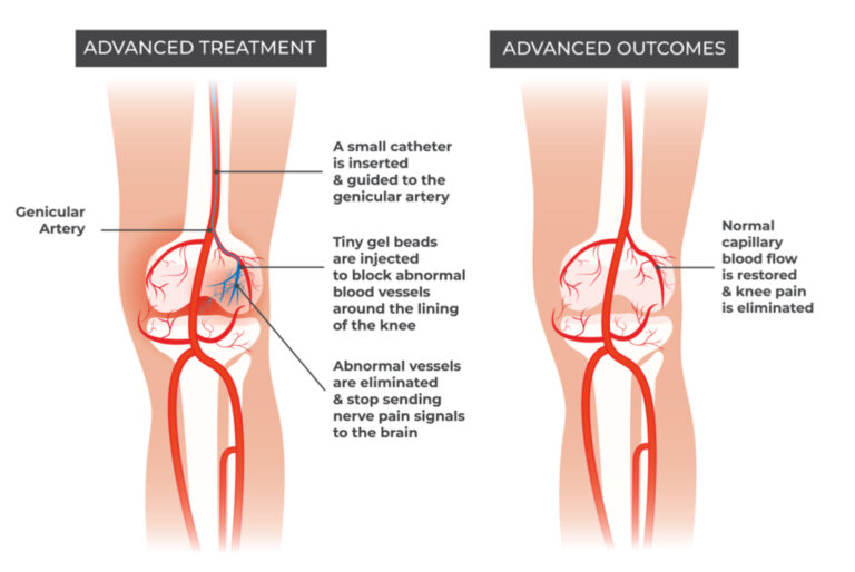 Genicular Artery Embolization: Knee Pain Relief Breakthrough