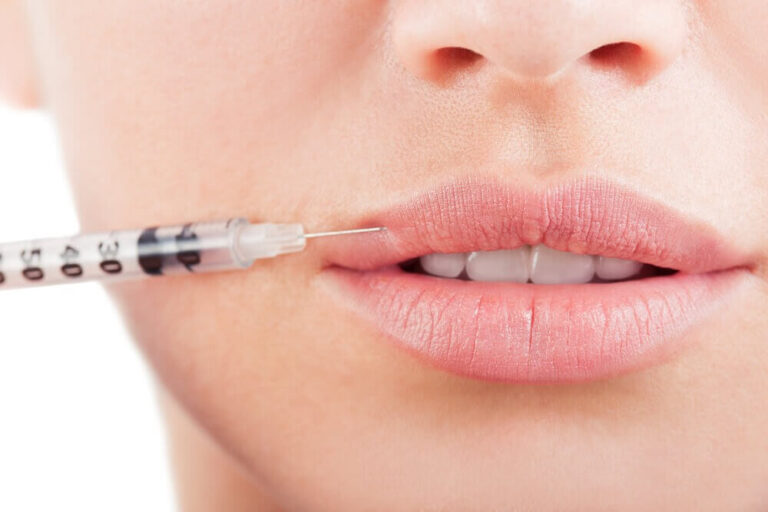 Most Effective Lip Filler Techniques in Dubai