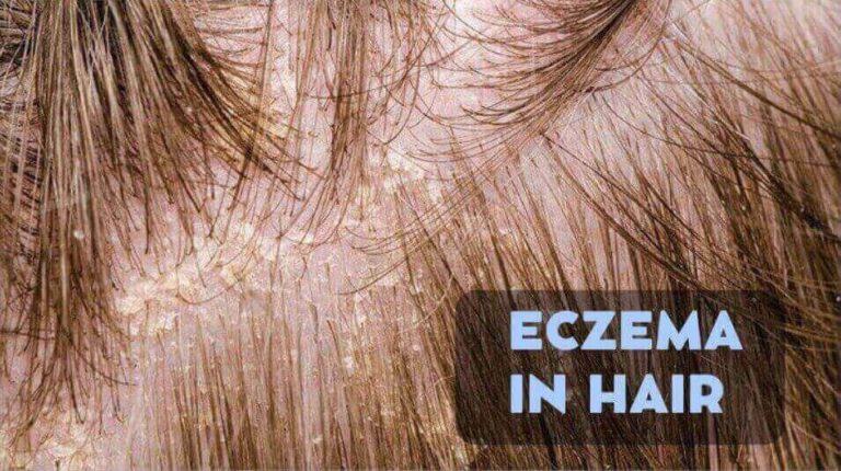 Eczema and Hair Loss: Uncovering the Surprising Connection