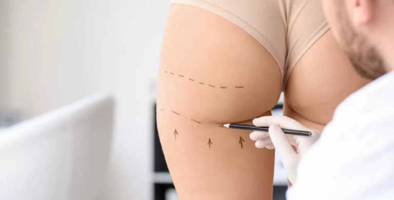 The Role of Liposuction in Butt Fat Transfer in Dubai