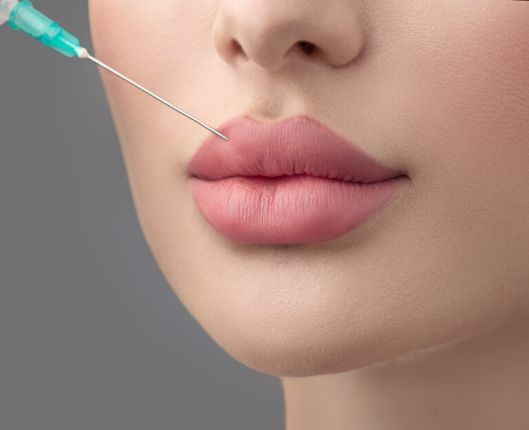 The Popularity of Russian Lip Fillers in Dubai