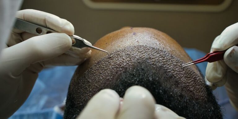 Hair Transplant in Lahore: A Comprehensive Guide