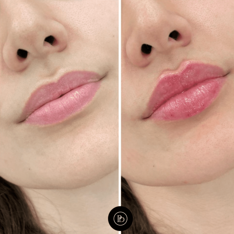 Juvederm Fillers in Dubai: The Secret to Youthful, Plump Lips