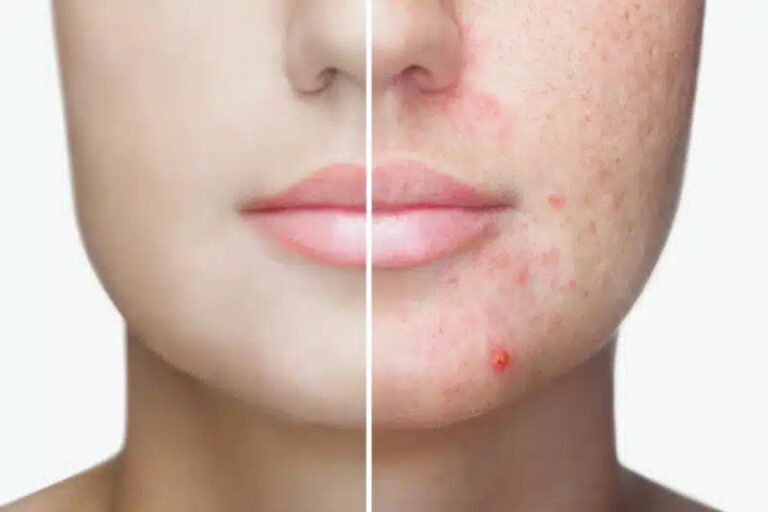 Redness Skin Treatment Southampton: Effective Solutions and Care